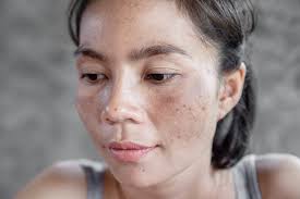 What Causes Melasma? Understanding the Root Problems Behind Pigmentation