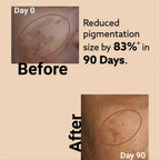 Melora Skin™ – India’s First Root-Cause Solution for Melasma & Pigmentation